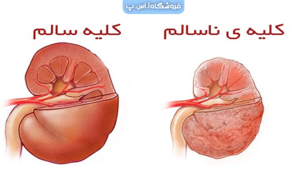 نارسایی کلیه چیست و چه علائمی دارد ؟ 